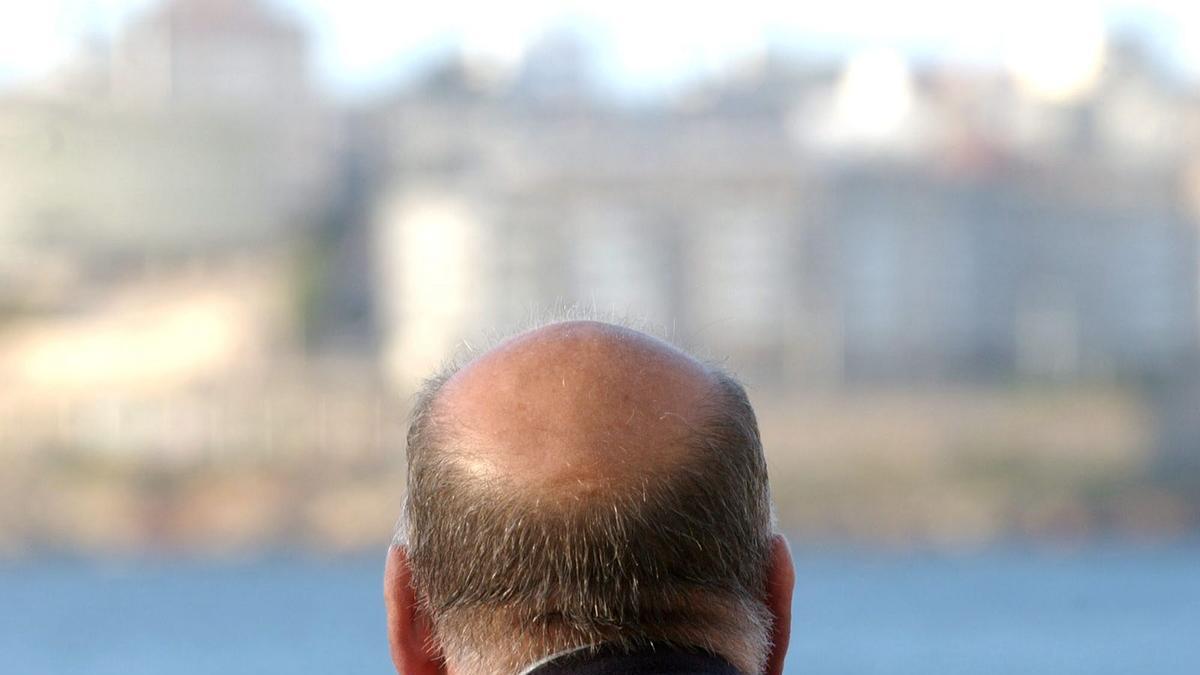 La alopecia androgénica afectará en algún momento de su vida al 80 % de los hombres